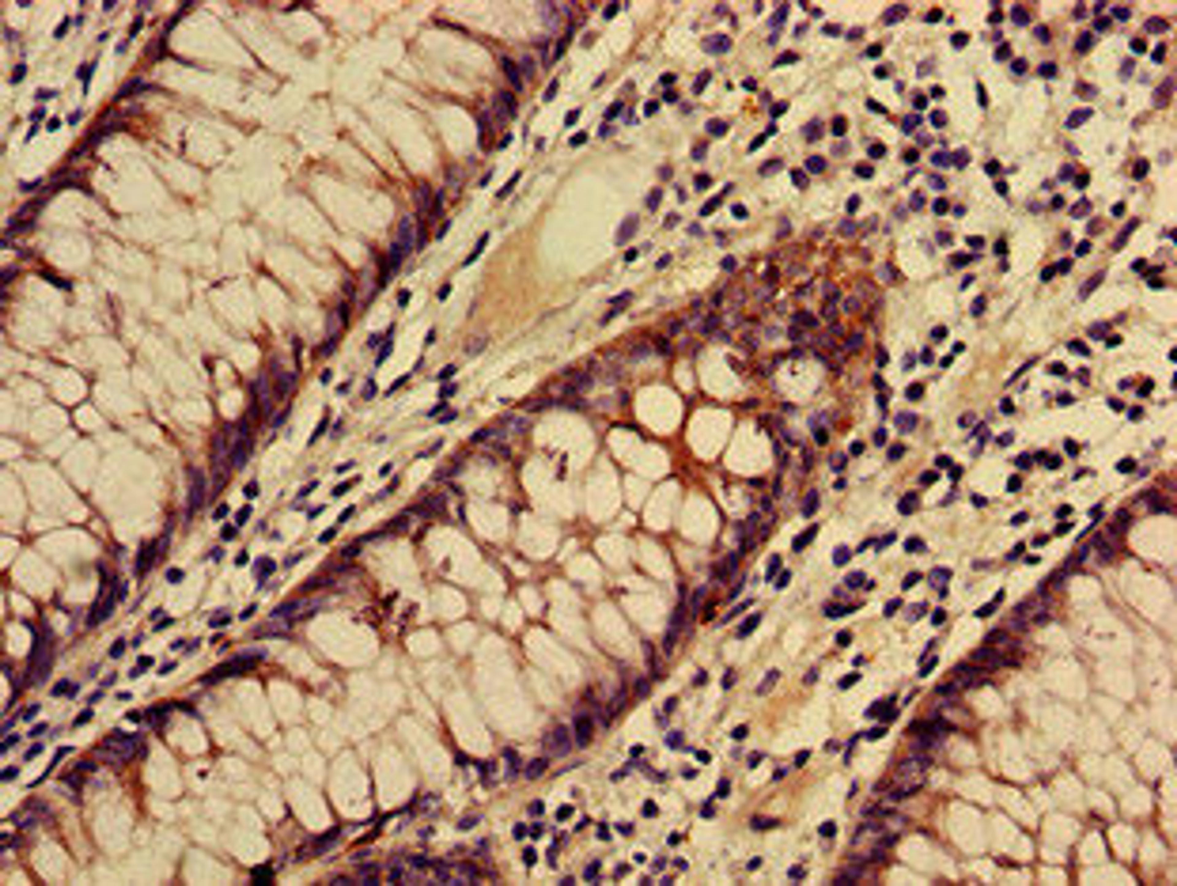 Immunohistochemistry of paraffin-embedded human colon cancer using CSB-PA025166LA01HU at dilution of 1:100