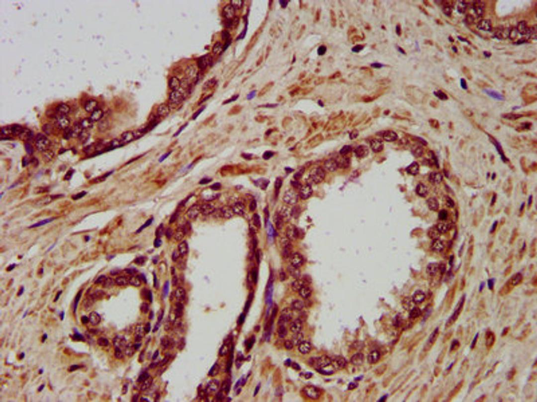IHC image of CSB-PA613507LA01HU diluted at 1:400 and staining in paraffin-embedded human prostate cancer performed on a Leica BondTM system. After dewaxing and hydration, antigen retrieval was mediated by high pressure in a citrate buffer (pH 6.0). Section was blocked with 10% normal goat serum 30min at RT. Then primary antibody (1% BSA) was incubated at 4&deg;C overnight. The primary is detected by a biotinylated secondary antibody and visualized using an HRP conjugated SP system.