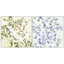 Immunohistochemical analysis of paraffin-embedded human breast carcinoma tissue using DNA-PK antibody.