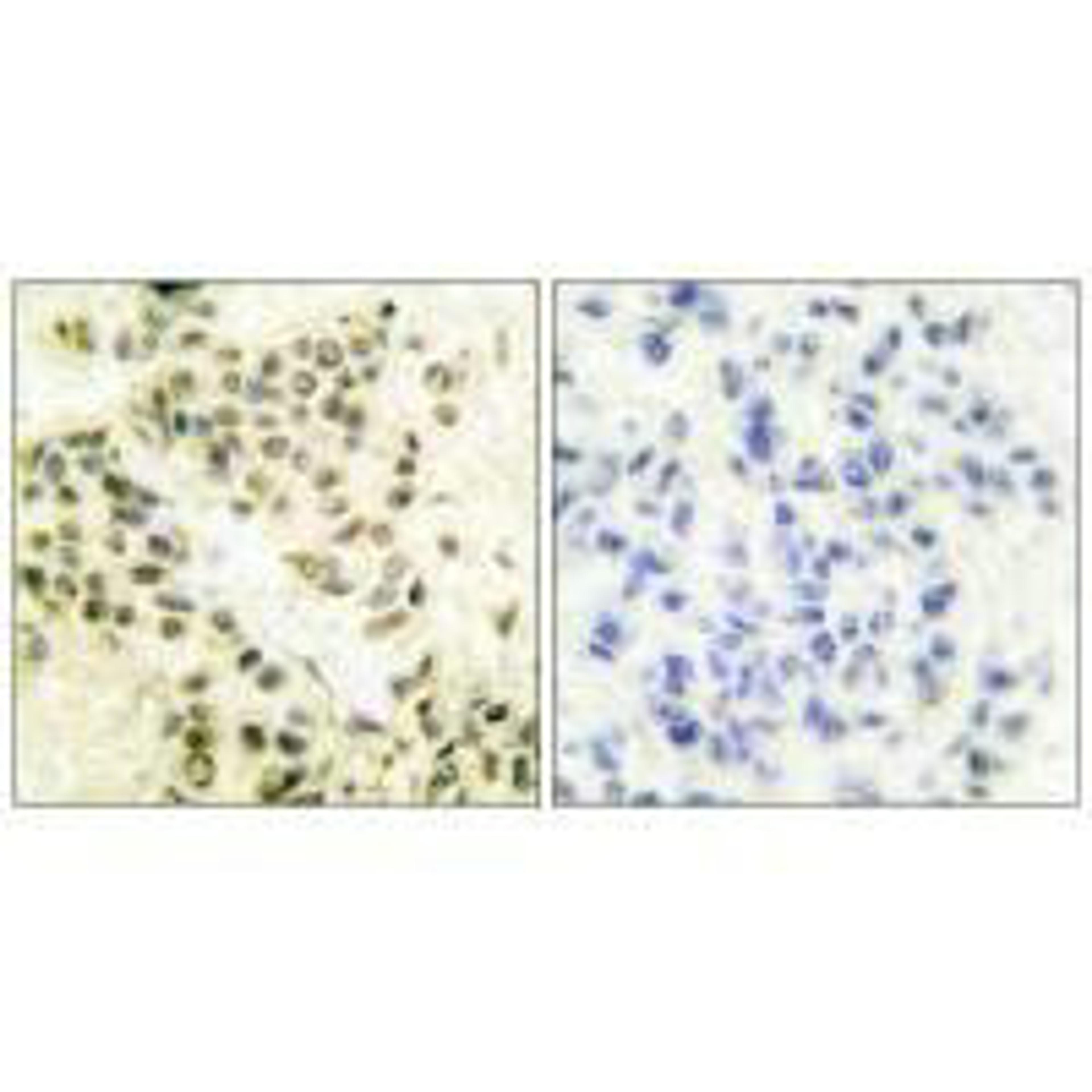 Immunohistochemical analysis of paraffin-embedded human breast carcinoma tissue using DNA-PK antibody.
