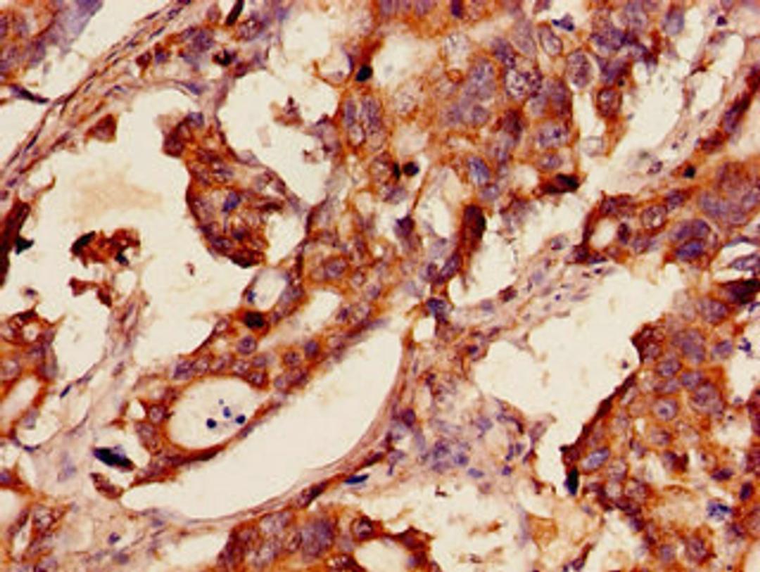 Immunohistochemistry of paraffin-embedded human gastric cancer using CSB-PA009968LA01HU at dilution of 1:100