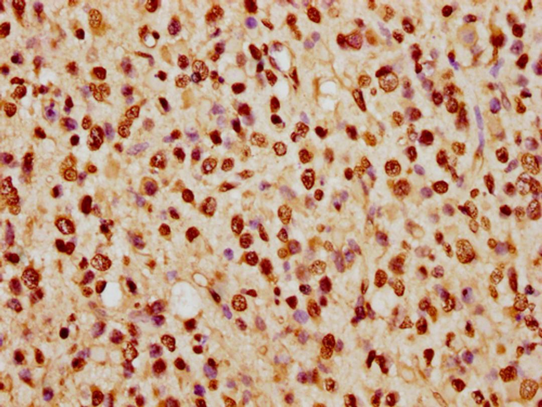 IHC image of CSB-PA010389PA74nhibHU diluted at 1:5 and staining in paraffin-embedded human glioma cancer performed on a Leica BondTM system. After dewaxing and hydration, antigen retrieval was mediated by high pressure in a citrate buffer (pH 6.0). Section was blocked with 10% normal goat serum 30min at RT. Then primary antibody (1% BSA) was incubated at 4°C overnight. The primary is detected by a biotinylated secondary antibody and visualized using an HRP conjugated SP system.