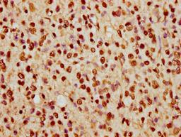 IHC image of CSB-PA010389PA74nhibHU diluted at 1:5 and staining in paraffin-embedded human glioma cancer performed on a Leica BondTM system. After dewaxing and hydration, antigen retrieval was mediated by high pressure in a citrate buffer (pH 6.0). Section was blocked with 10% normal goat serum 30min at RT. Then primary antibody (1% BSA) was incubated at 4°C overnight. The primary is detected by a biotinylated secondary antibody and visualized using an HRP conjugated SP system.