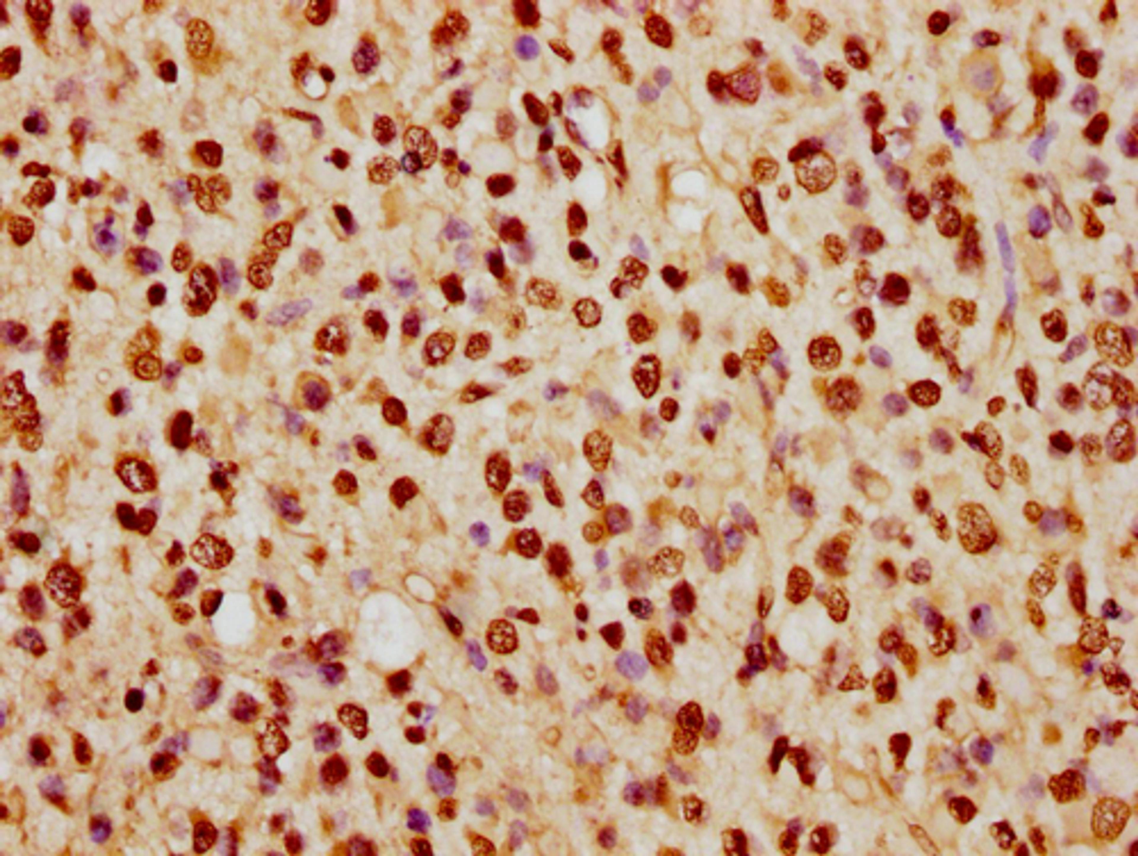 IHC image of CSB-PA010389PA74nhibHU diluted at 1:5 and staining in paraffin-embedded human glioma cancer performed on a Leica BondTM system. After dewaxing and hydration, antigen retrieval was mediated by high pressure in a citrate buffer (pH 6.0). Section was blocked with 10% normal goat serum 30min at RT. Then primary antibody (1% BSA) was incubated at 4°C overnight. The primary is detected by a biotinylated secondary antibody and visualized using an HRP conjugated SP system.