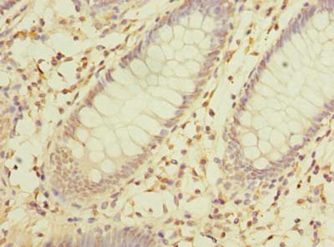 Immunohistochemistry of paraffin-embedded human colon cancer using CSB-PA882128LA01HU at dilution of 1:100