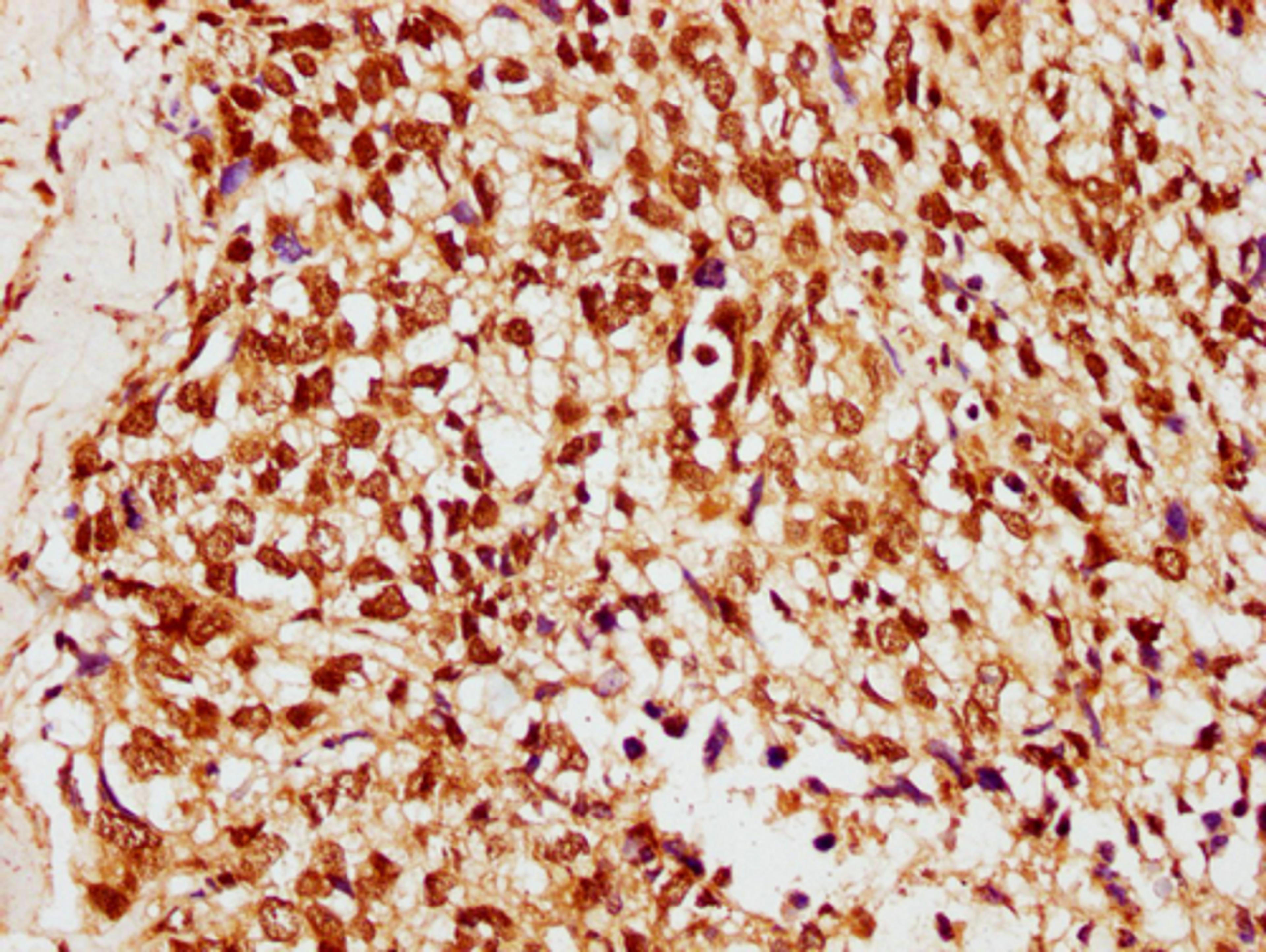 IHC image of CSB-PA010378OA33ncrHU diluted at 1:10 and staining in paraffin-embedded human ovarian cancer performed on a Leica BondTM system. After dewaxing and hydration, antigen retrieval was mediated by high pressure in a citrate buffer (pH 6.0). Section was blocked with 10% normal goat serum 30min at RT. Then primary antibody (1% BSA) was incubated at 4°C overnight. The primary is detected by a biotinylated secondary antibody and visualized using an HRP conjugated SP system.