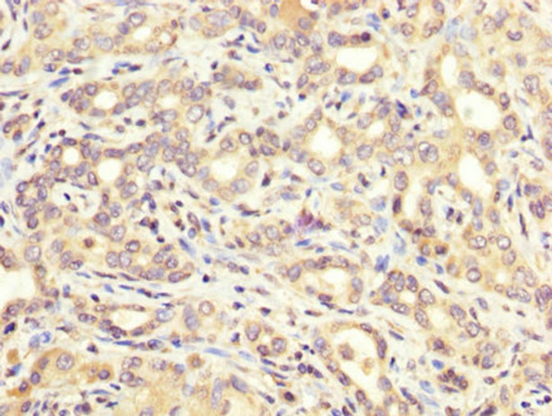 IHC image of CSB-PA002268LA01HU diluted at 1:200 and staining in paraffin-embedded human liver cancer performed on a Leica BondTM system. After dewaxing and hydration, antigen retrieval was mediated by high pressure in a citrate buffer (pH 6.0). Section was blocked with 10% normal goat serum 30min at RT. Then primary antibody (1% BSA) was incubated at 4&deg;C overnight. The primary is detected by a biotinylated secondary antibody and visualized using an HRP conjugated SP system.