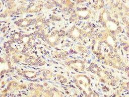IHC image of CSB-PA002268LA01HU diluted at 1:200 and staining in paraffin-embedded human liver cancer performed on a Leica BondTM system. After dewaxing and hydration, antigen retrieval was mediated by high pressure in a citrate buffer (pH 6.0). Section was blocked with 10% normal goat serum 30min at RT. Then primary antibody (1% BSA) was incubated at 4&deg;C overnight. The primary is detected by a biotinylated secondary antibody and visualized using an HRP conjugated SP system.