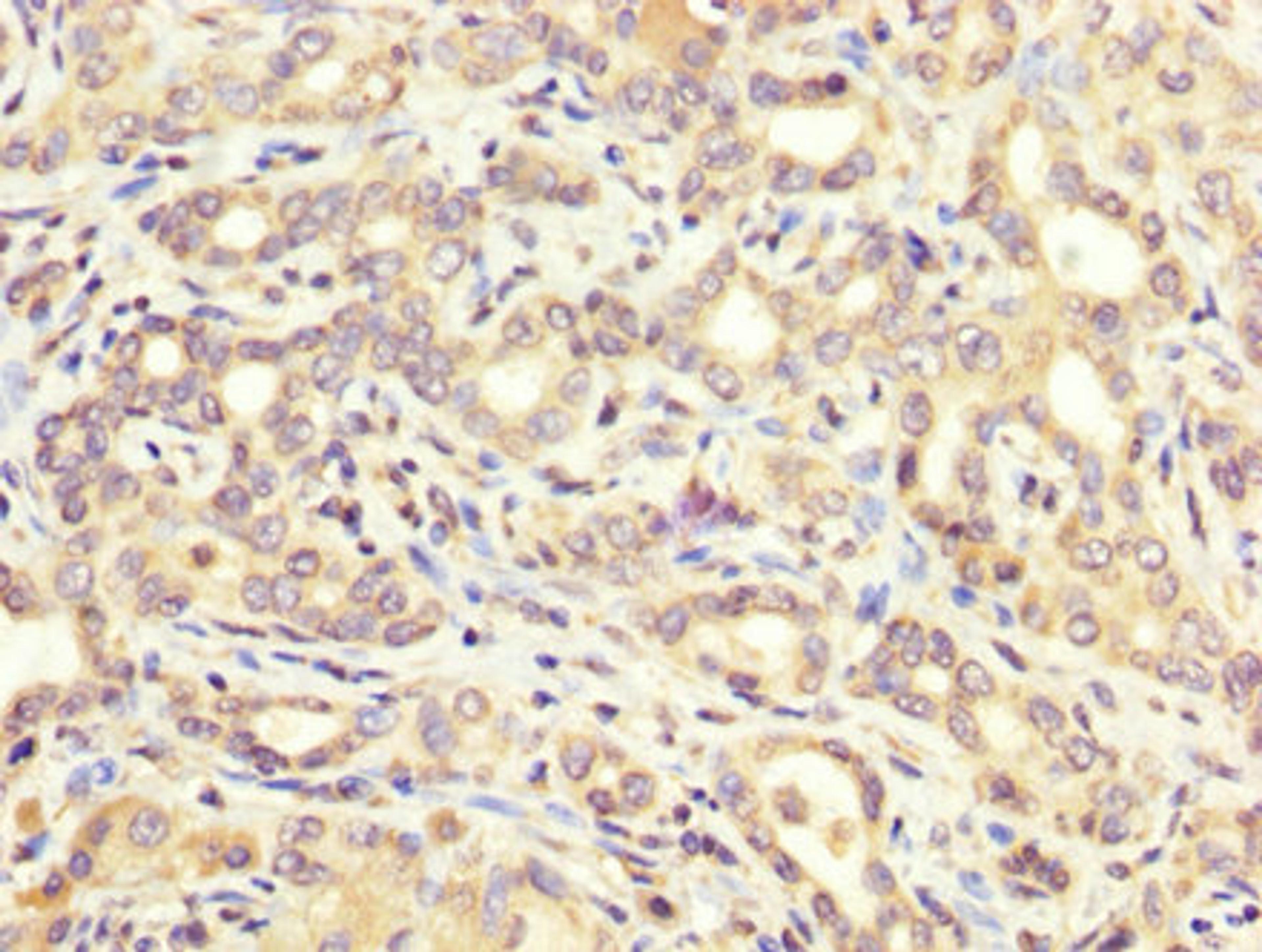 IHC image of CSB-PA002268LA01HU diluted at 1:200 and staining in paraffin-embedded human liver cancer performed on a Leica BondTM system. After dewaxing and hydration, antigen retrieval was mediated by high pressure in a citrate buffer (pH 6.0). Section was blocked with 10% normal goat serum 30min at RT. Then primary antibody (1% BSA) was incubated at 4&deg;C overnight. The primary is detected by a biotinylated secondary antibody and visualized using an HRP conjugated SP system.