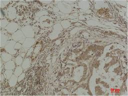 Immunohistochemical analysis of paraffin-embedded Human Breast Carcinoma using Pan Methylated Lysine Monoclonal Antibody.