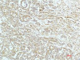Immunohistochemical analysis of paraffin-embedded Human Breast Carrcinoma Tissue using a-actinin Mouse mAb diluted at 1:200.