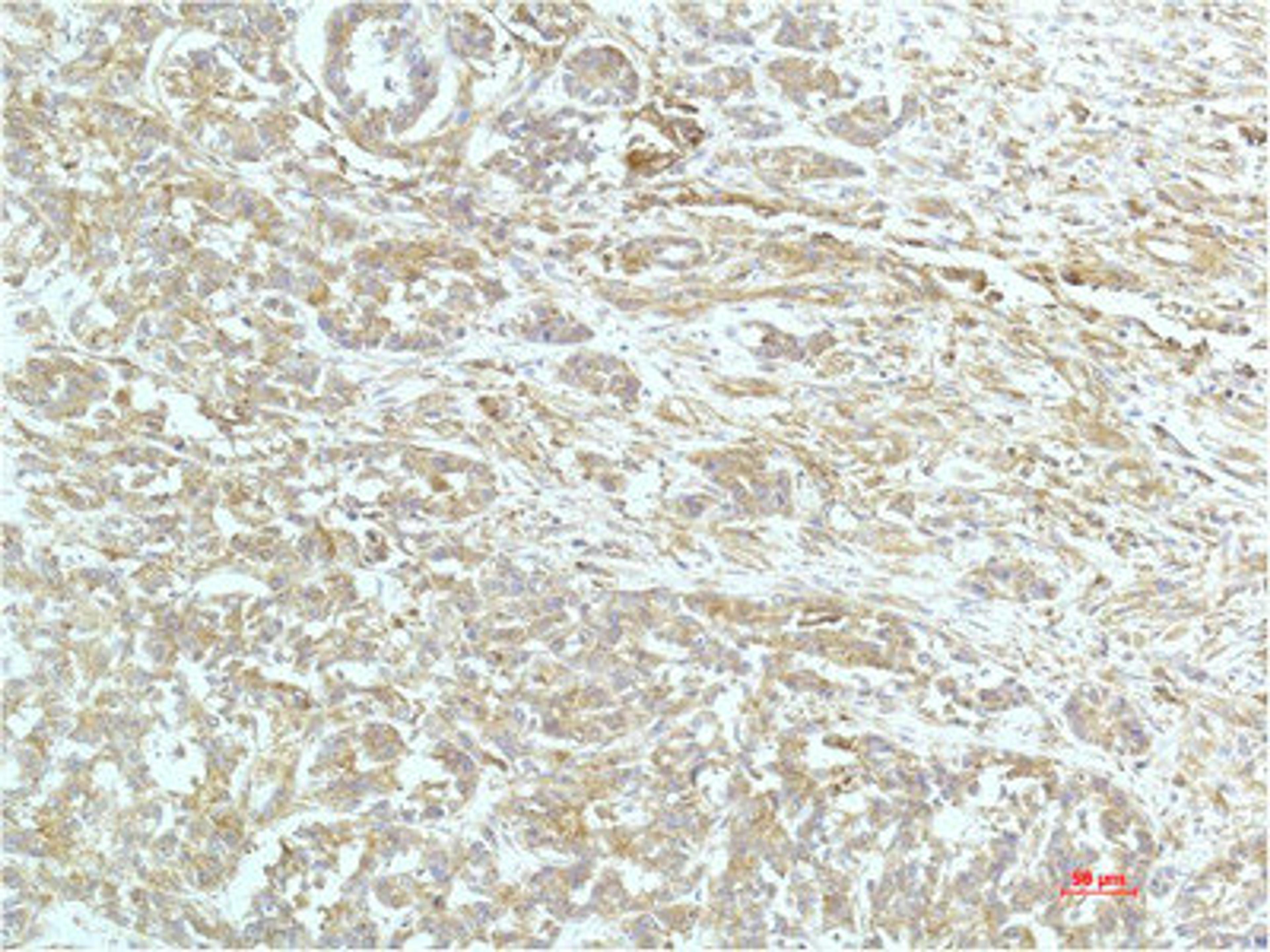 Immunohistochemical analysis of paraffin-embedded Human Breast Carrcinoma Tissue using a-actinin Mouse mAb diluted at 1:200.