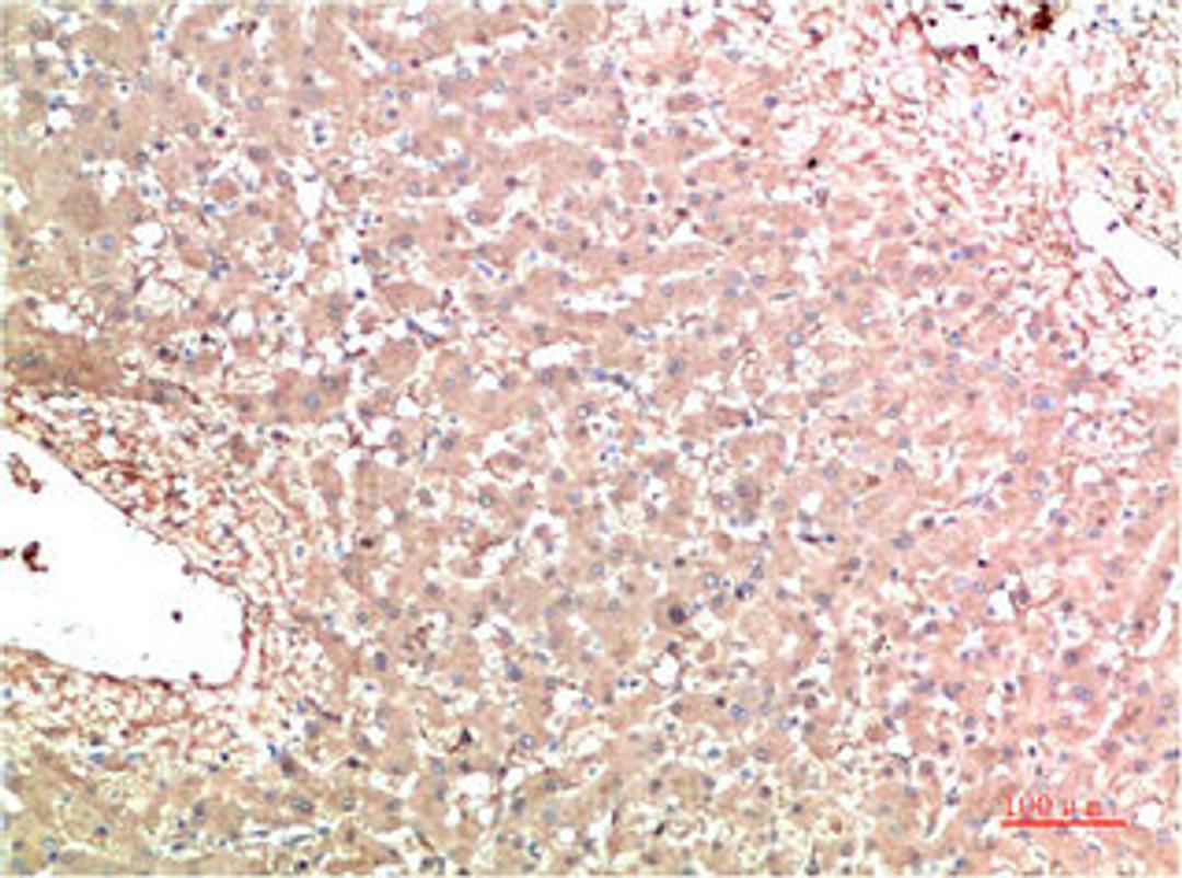 Immunohistochemical analysis of paraffin-embedded Human Liver Carcinoma Tissue using TTR Mouse mAb diluted at 1:200.