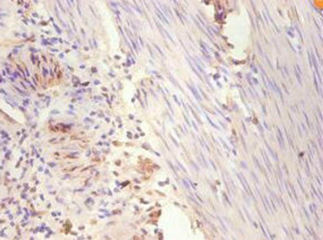 Immunohistochemistry of paraffin-embedded human breast cancer using CSB-PA007830YA01HU at dilution of 1:100