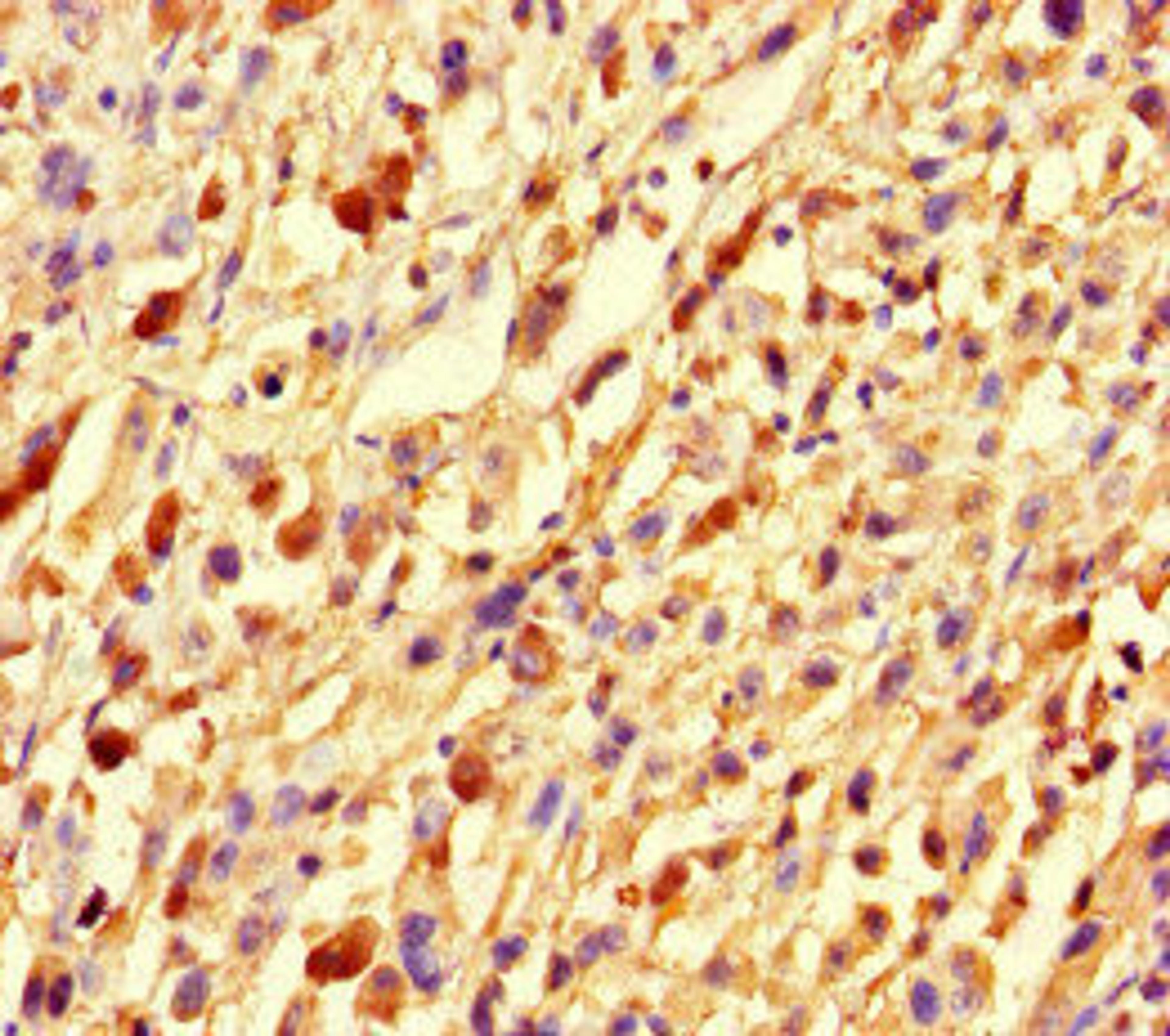 Immunohistochemistry of paraffin-embedded human melanoma using CSB-PA878952LA01HU at dilution of 1:100