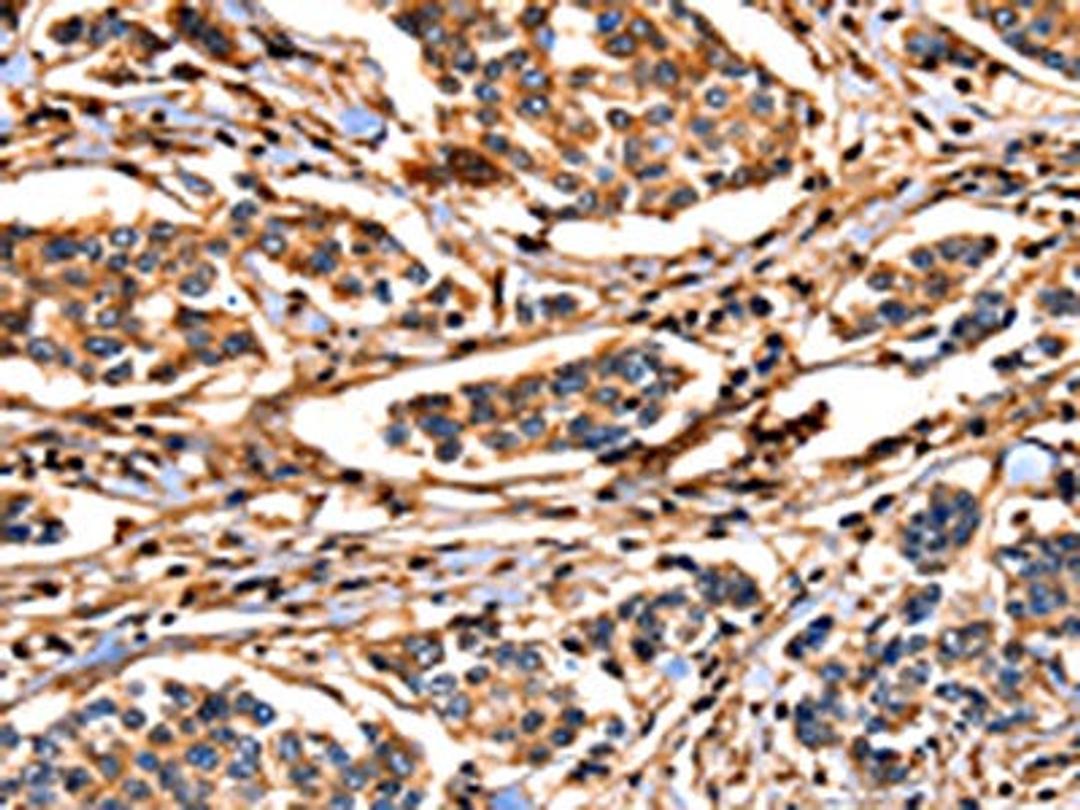 The image on the left is immunohistochemistry of paraffin-embedded Human breast cancer tissue using CSB-PA197126(ANXA6 Antibody) at dilution 1/17, on the right is treated with fusion protein. (Original magnification: ×200)