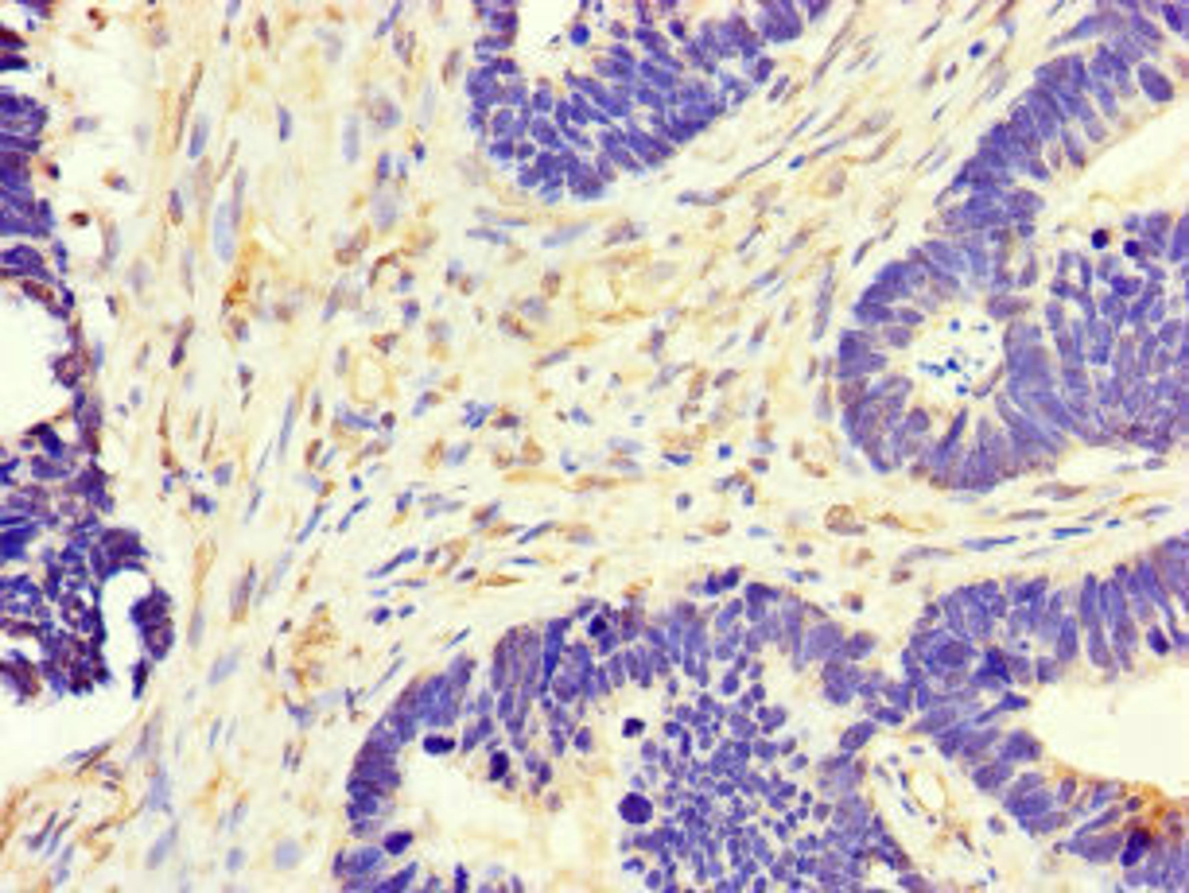 Immunohistochemistry of paraffin-embedded human ovarian cancer using CSB-PA015072LA01HU at dilution of 1:100