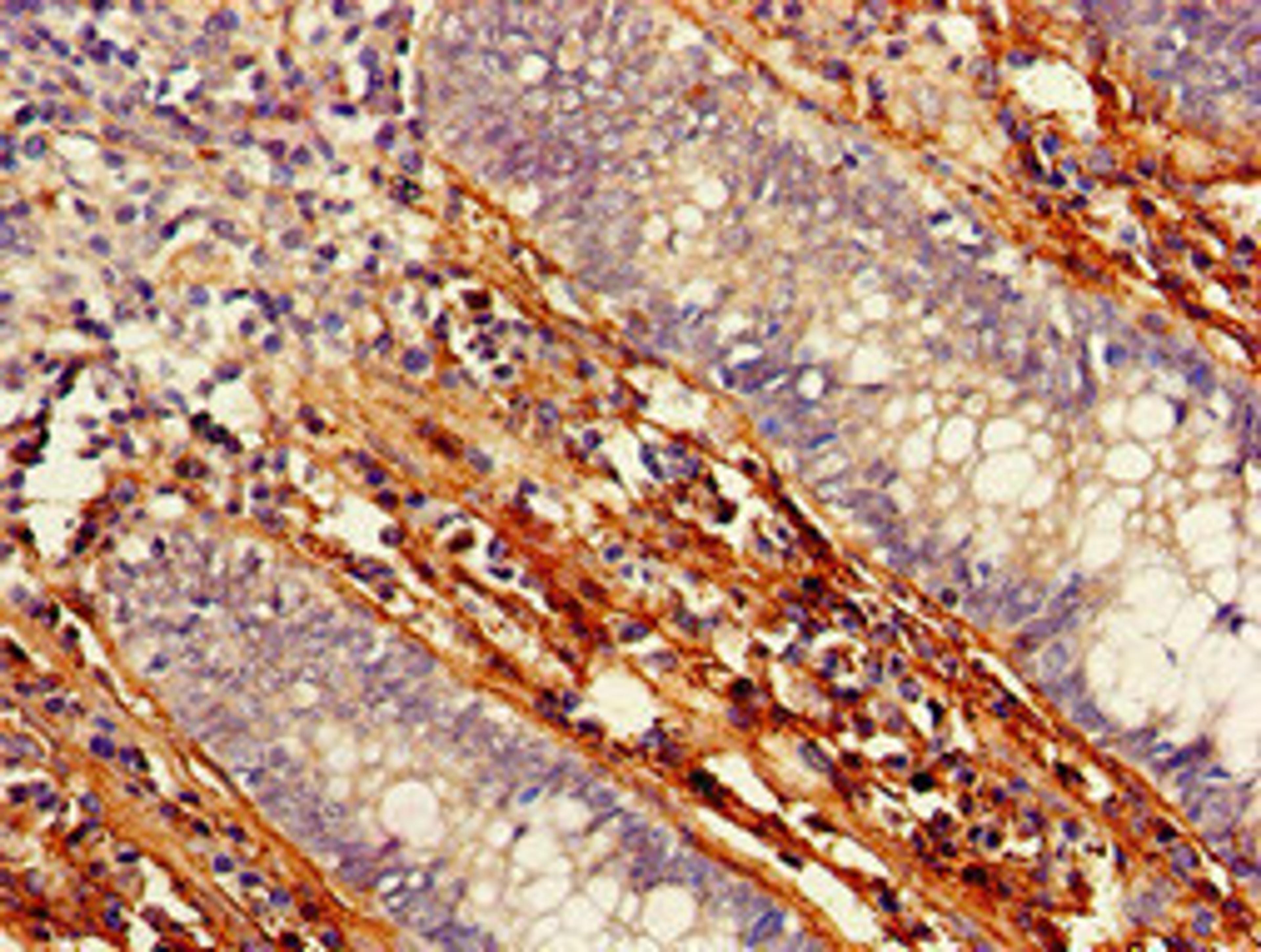 Immunohistochemistry of paraffin-embedded human colon cancer using CSB-PA623823LA01HU at dilution of 1:100