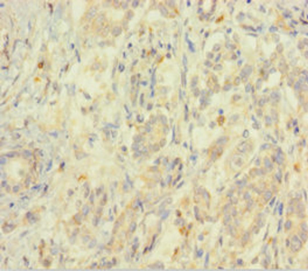 Immunohistochemistry of paraffin-embedded human pancreatic cancer using CSB-PA007572HA01HU at dilution of 1:100