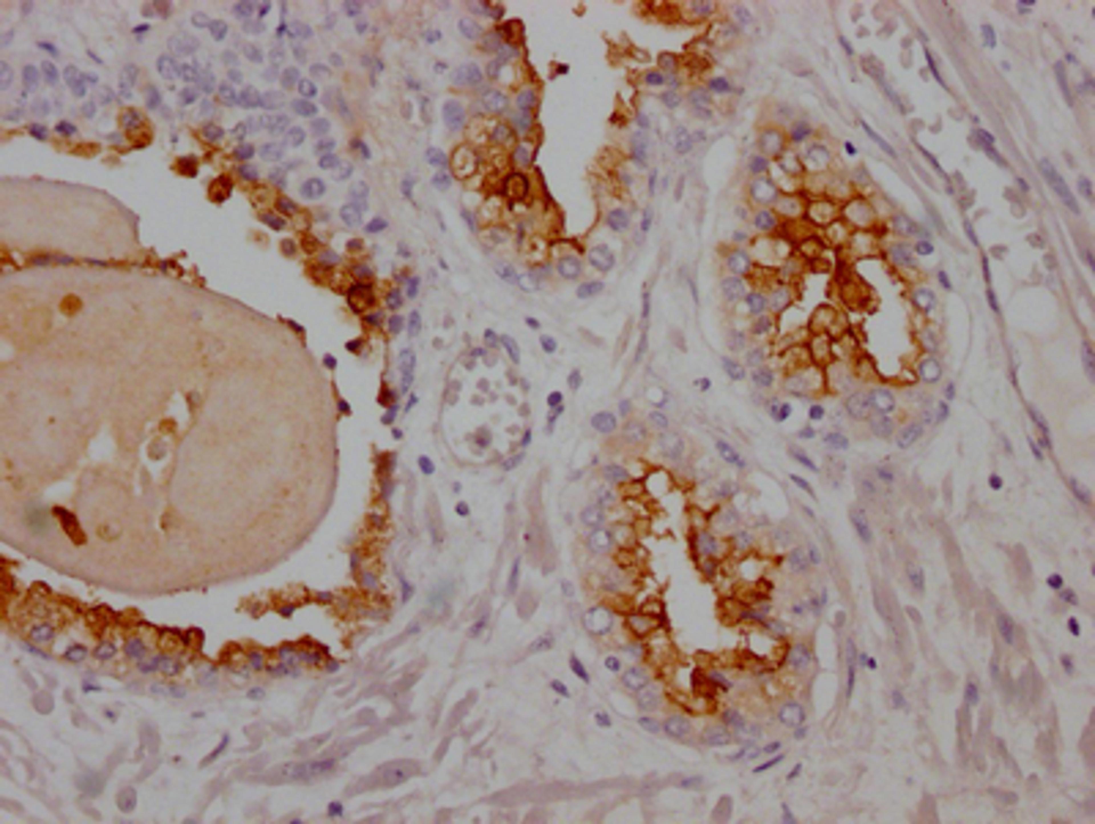 IHC image of CSB-RA162924A0HU diluted at 1:100 and staining in paraffin-embedded human prostate cancer performed on a Leica BondTM system. After dewaxing and hydration, antigen retrieval was mediated by high pressure in a citrate buffer (pH 6.0). Section was blocked with 10% normal goat serum 30min at RT. Then primary antibody (1% BSA) was incubated at 4℃ overnight. The primary is detected by a Goat anti-rabbit IgG polymer labeled by HRP and visualized using 0.05% DAB.