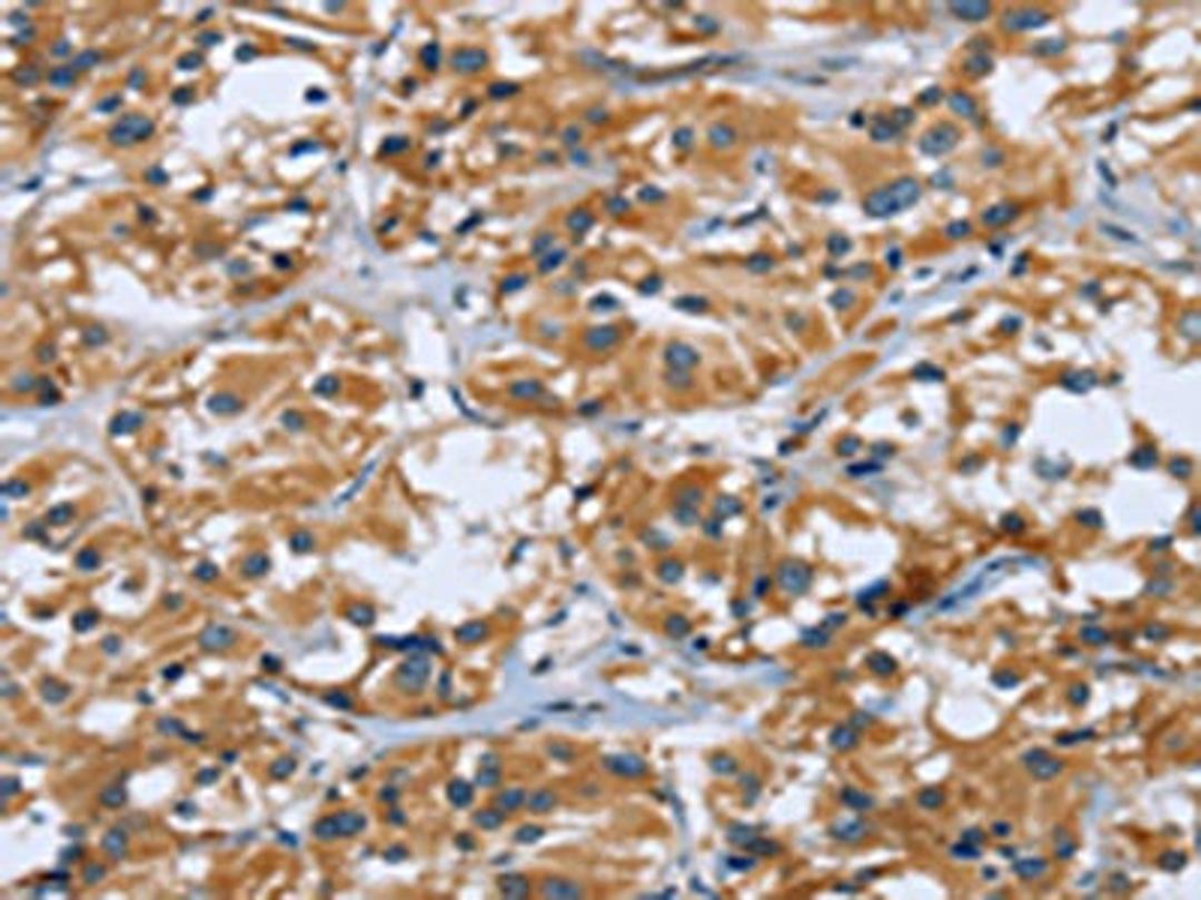 The image on the left is immunohistochemistry of paraffin-embedded Human thyroid cancer tissue using CSB-PA834666(RAP1B Antibody) at dilution 1/40, on the right is treated with fusion protein. (Original magnification: ×200)