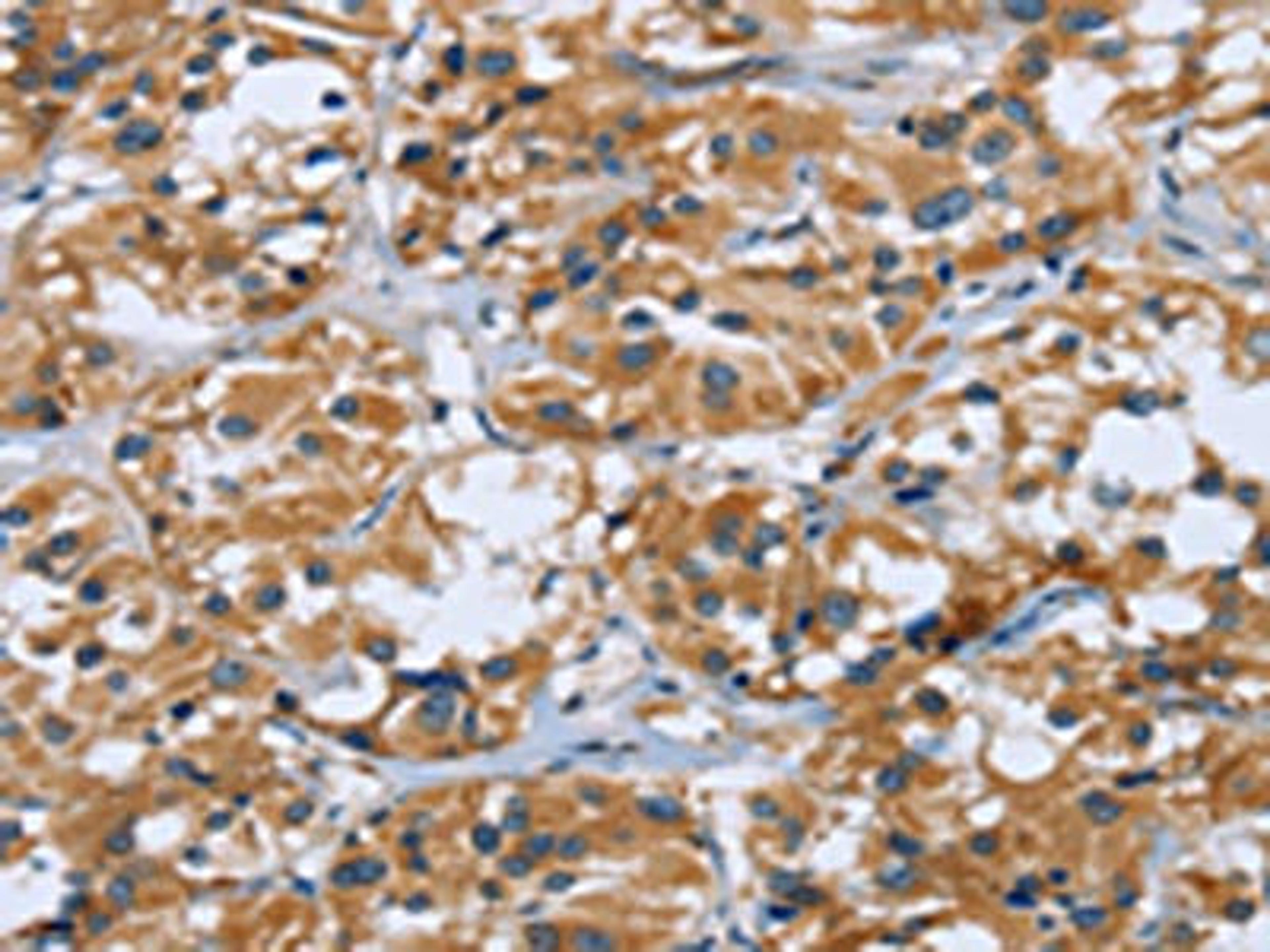 The image on the left is immunohistochemistry of paraffin-embedded Human thyroid cancer tissue using CSB-PA834666(RAP1B Antibody) at dilution 1/40, on the right is treated with fusion protein. (Original magnification: ×200)
