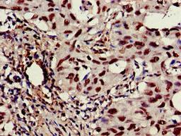 Immunohistochemistry of paraffin-embedded human lung cancer using CSB-PA004551EA01HU at dilution of 1:100