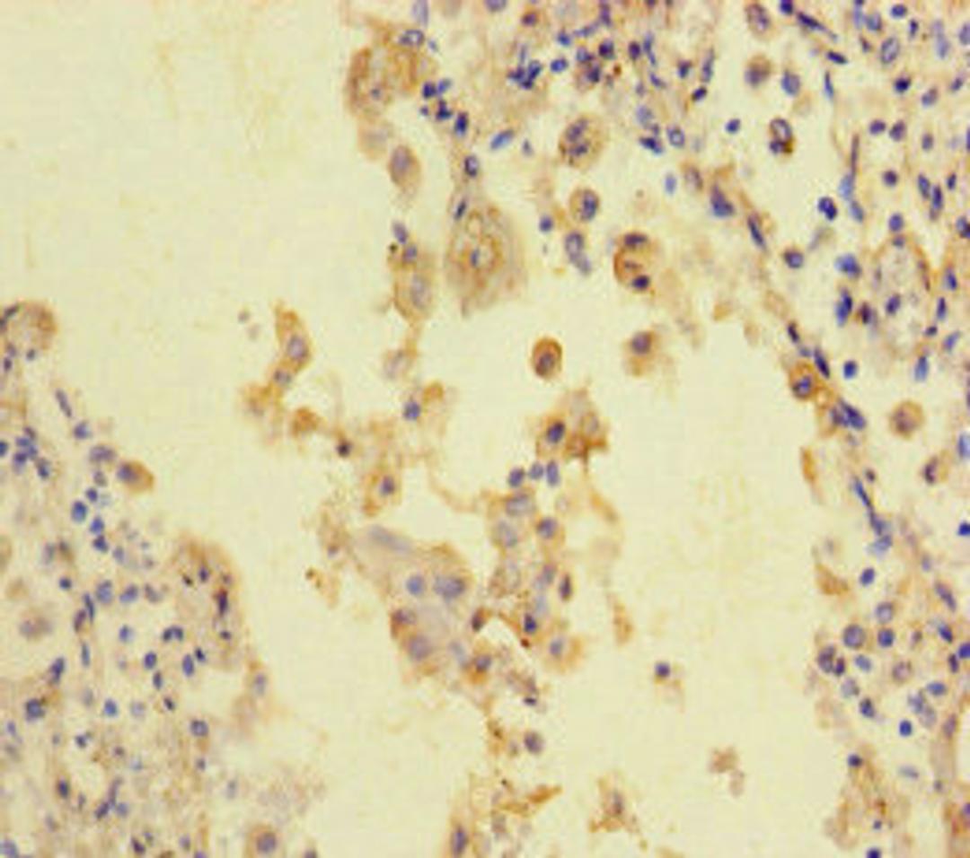 Immunohistochemistry of paraffin-embedded human lung cancer using CSB-PA618008LA01HU at dilution of 1:100