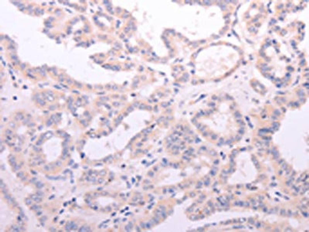 The image on the left is immunohistochemistry of paraffin-embedded Human thyroid cancer tissue using CSB-PA035040(ACOT2 Antibody) at dilution 1/15, on the right is treated with fusion protein. (Original magnification: ×200)