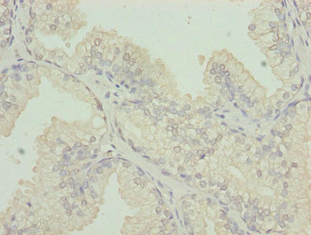 Immunohistochemistry of paraffin-embedded human prostate cancer using CSB-PA006031LA01HU at dilution of 1:100