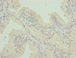Immunohistochemistry of paraffin-embedded human prostate cancer using CSB-PA006031LA01HU at dilution of 1:100