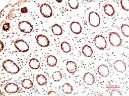Immunohistochemical analysis of paraffin-embedded Human Colon Carcinoma Tissue using Collagen I  Mouse mAb diluted at 1:200.