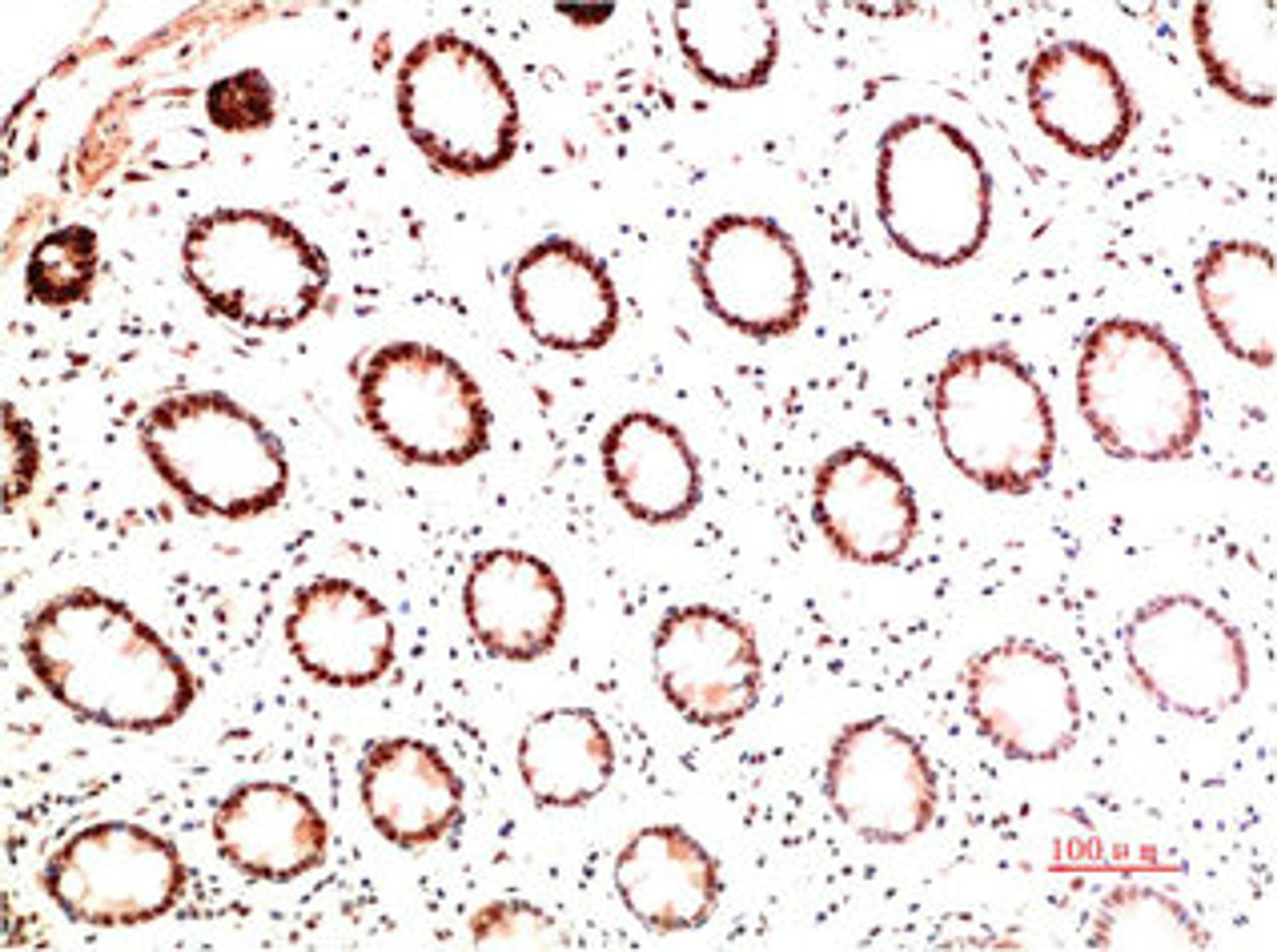 Immunohistochemical analysis of paraffin-embedded Human Colon Carcinoma Tissue using Collagen I  Mouse mAb diluted at 1:200.