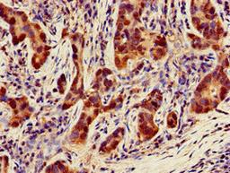 Immunohistochemistry of paraffin-embedded human pancreatic cancer using CSB-PA016039LA01HU at dilution of 1:100