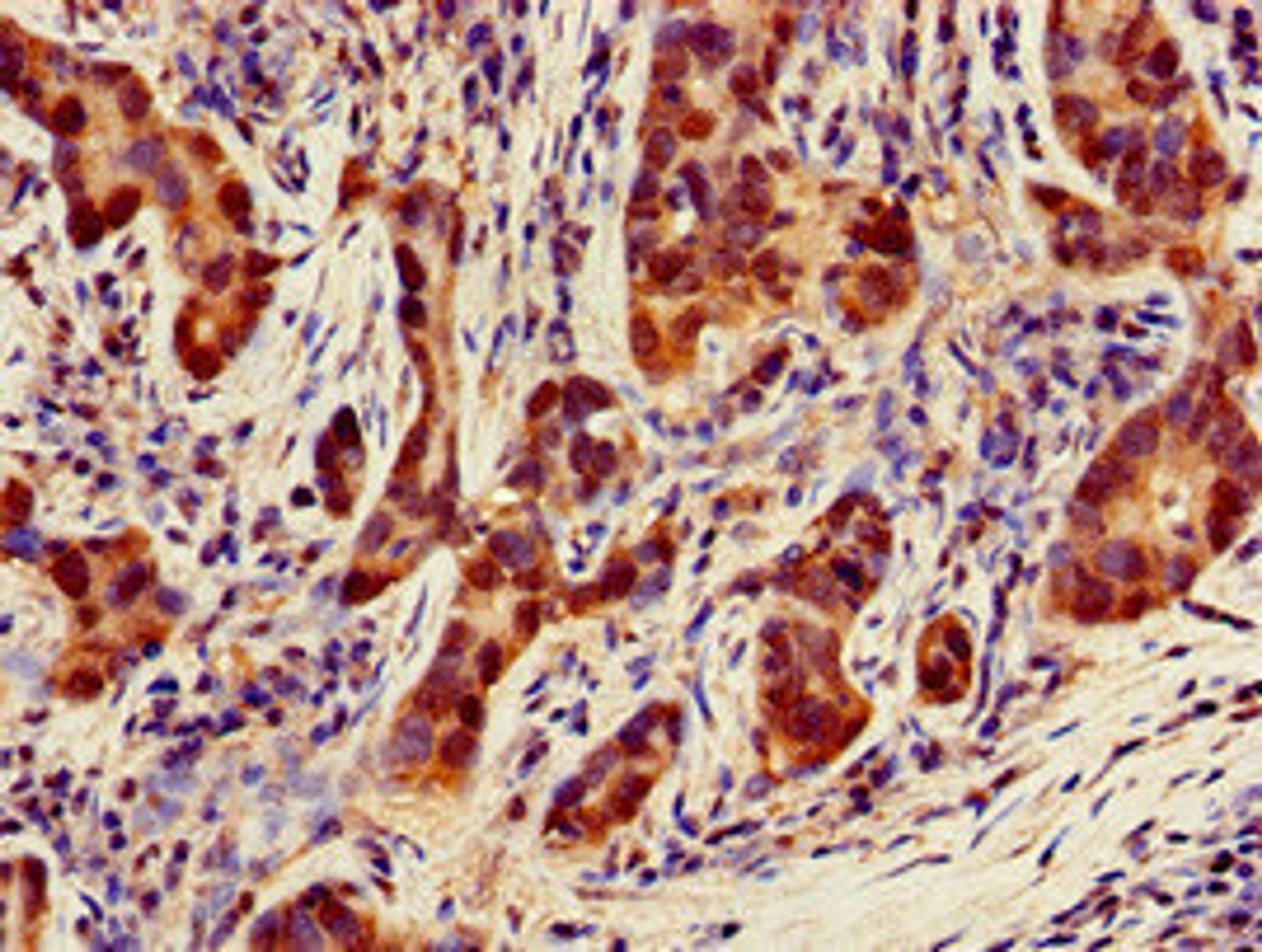 Immunohistochemistry of paraffin-embedded human pancreatic cancer using CSB-PA016039LA01HU at dilution of 1:100