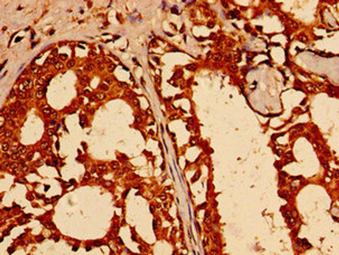 Immunohistochemistry of paraffin-embedded human breast cancer using CSB-PA842150LA01HU at dilution of 1:100