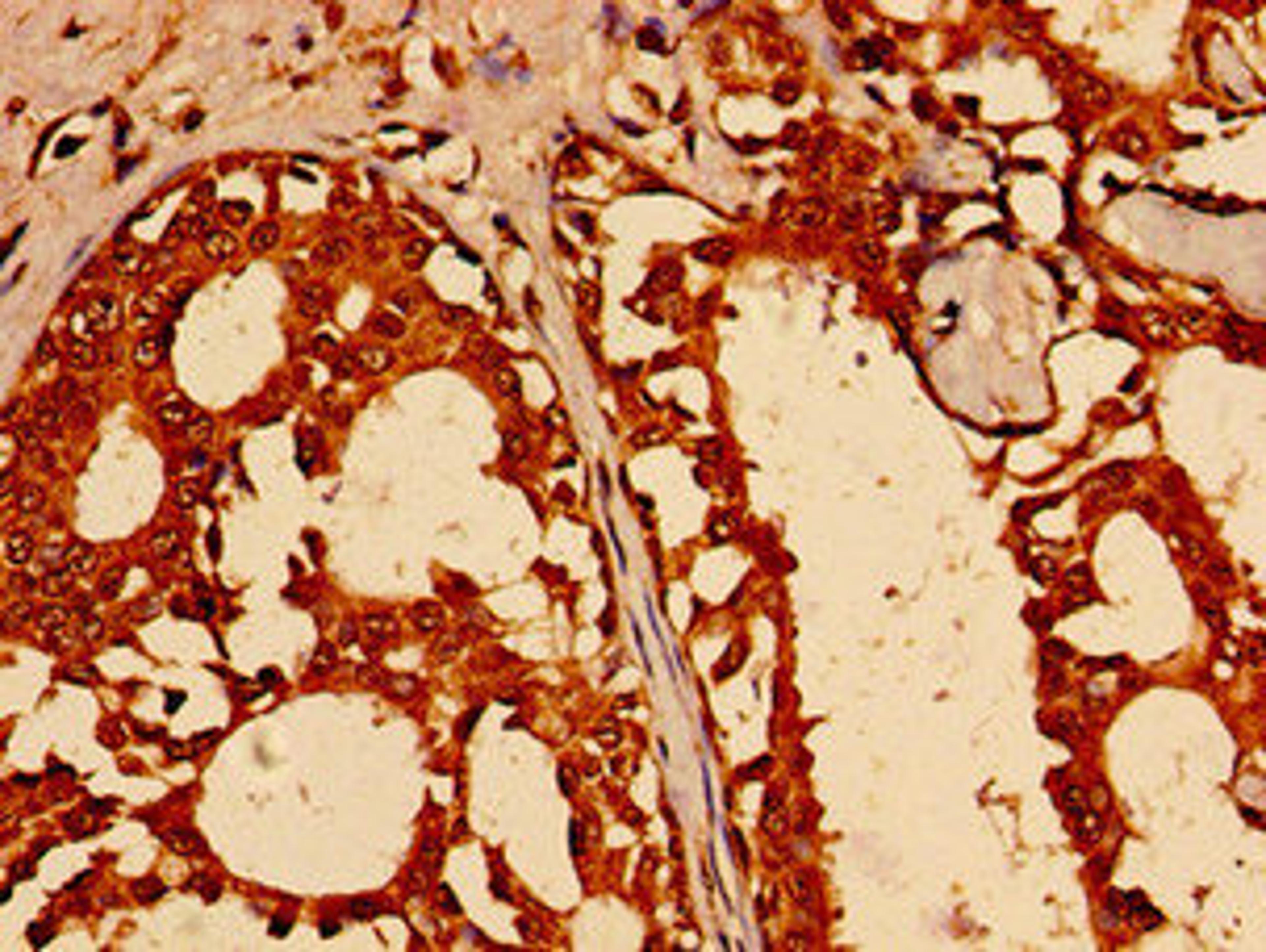 Immunohistochemistry of paraffin-embedded human breast cancer using CSB-PA842150LA01HU at dilution of 1:100