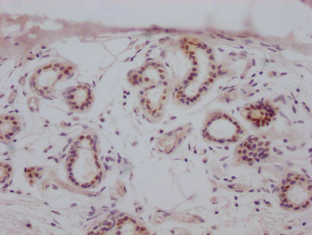 IHC image of CSB-RA942338A0HU diluted at 1:100 and staining in paraffin-embedded human breast cancer performed on a Leica BondTM system. After dewaxing and hydration, antigen retrieval was mediated by high pressure in a citrate buffer (pH 6.0). Section was blocked with 10% normal goat serum 30min at RT. Then primary antibody (1% BSA) was incubated at 4℃ overnight. The primary is detected by a Goat anti-rabbit IgG polymer labeled by HRP and visualized using 0.05% DAB.