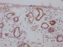 IHC image of CSB-RA942338A0HU diluted at 1:100 and staining in paraffin-embedded human breast cancer performed on a Leica BondTM system. After dewaxing and hydration, antigen retrieval was mediated by high pressure in a citrate buffer (pH 6.0). Section was blocked with 10% normal goat serum 30min at RT. Then primary antibody (1% BSA) was incubated at 4℃ overnight. The primary is detected by a Goat anti-rabbit IgG polymer labeled by HRP and visualized using 0.05% DAB.