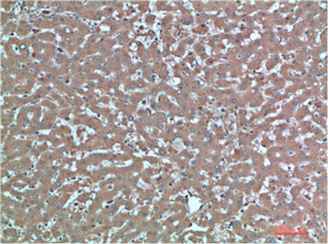 Immunohistochemical analysis of paraffin-embedded Human Liver Carcinoma Tissue using TTR Mouse mAb diluted at 1:200.