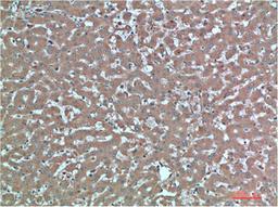 Immunohistochemical analysis of paraffin-embedded Human Liver Carcinoma Tissue using TTR Mouse mAb diluted at 1:200.