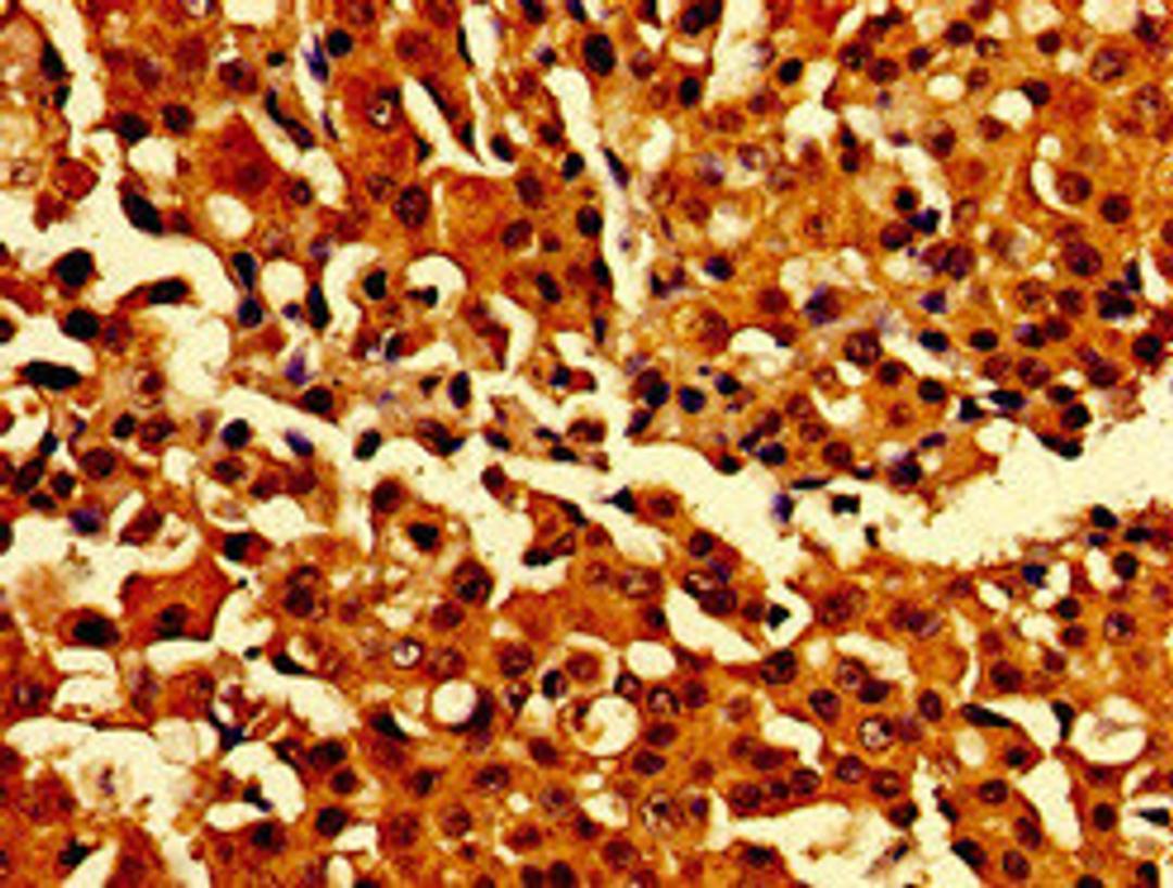 Immunohistochemistry of paraffin-embedded human breast cancer using CSB-PA883622LA01HU at dilution of 1:100