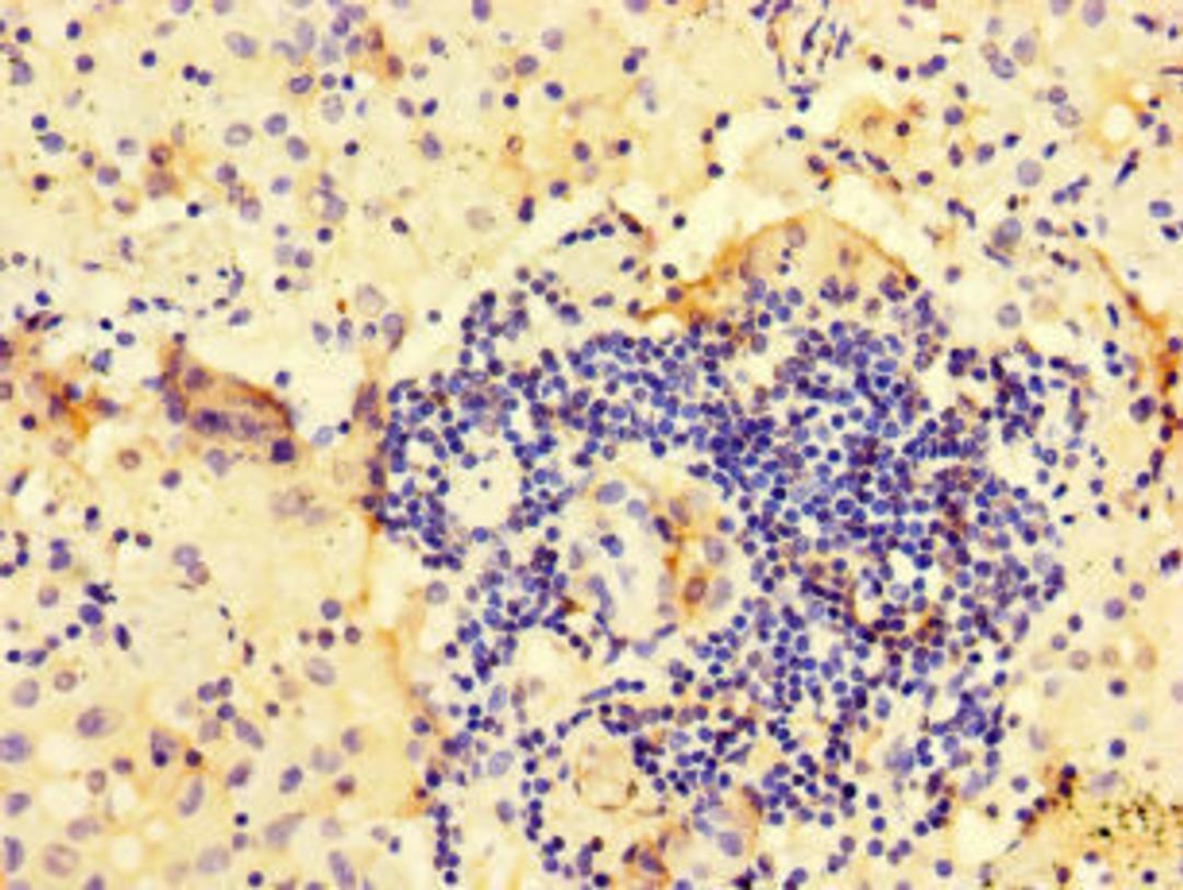 Immunohistochemistry of paraffin-embedded human lung cancer using CSB-PA002012LA01HU at dilution of 1:100