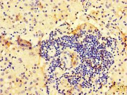 Immunohistochemistry of paraffin-embedded human lung cancer using CSB-PA002012LA01HU at dilution of 1:100