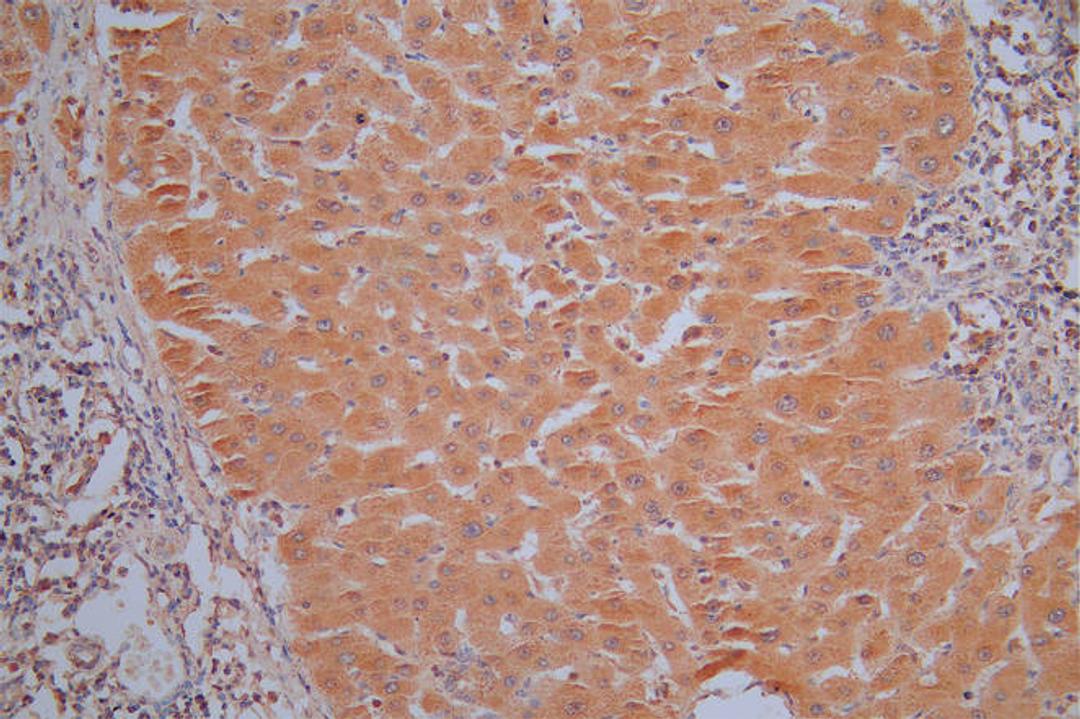 IHC image of CSB-RA001836MA1HU diluted at 1:30 and staining in paraffin-embedded human liver cancer performed on a Leica BondTM system. After dewaxing and hydration,  antigen retrieval was mediated by high pressure in a citrate buffer (pH 6.0). Section was blocked with 10% normal goat serum 30min at RT. Then primary antibody (1% BSA) was incubated at 4°C overnight. The primary is detected by a Goat anti-Mouse IgG labeled by HRP and visualized using 0.05% DAB.