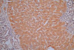 IHC image of CSB-RA001836MA1HU diluted at 1:30 and staining in paraffin-embedded human liver cancer performed on a Leica BondTM system. After dewaxing and hydration,  antigen retrieval was mediated by high pressure in a citrate buffer (pH 6.0). Section was blocked with 10% normal goat serum 30min at RT. Then primary antibody (1% BSA) was incubated at 4°C overnight. The primary is detected by a Goat anti-Mouse IgG labeled by HRP and visualized using 0.05% DAB.