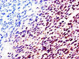 Immunohistochemistry of paraffin-embedded human glioma using CSB-PA013005LA01HU at dilution of 1:100