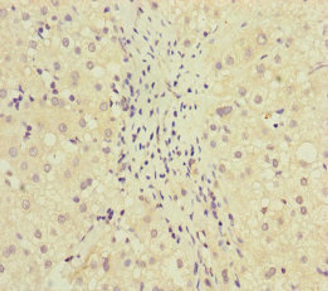 Immunohistochemistry of paraffin-embedded human liver cancer using CSB-PA853497ESR1HU at dilution of 1:100