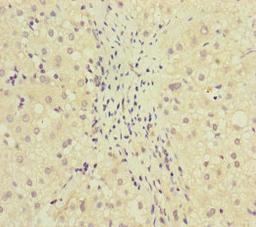 Immunohistochemistry of paraffin-embedded human liver cancer using CSB-PA853497ESR1HU at dilution of 1:100