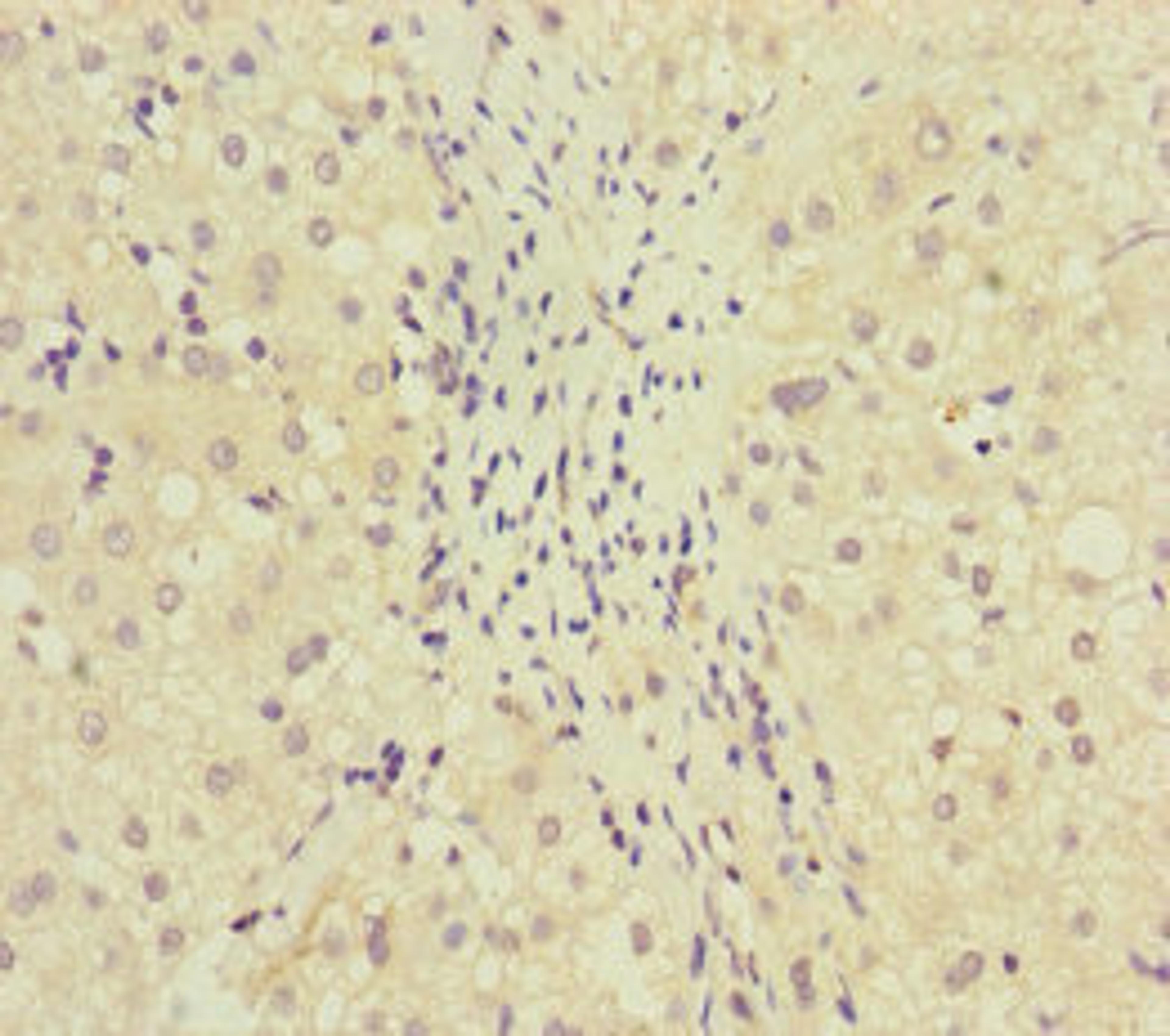 Immunohistochemistry of paraffin-embedded human liver cancer using CSB-PA853497ESR1HU at dilution of 1:100